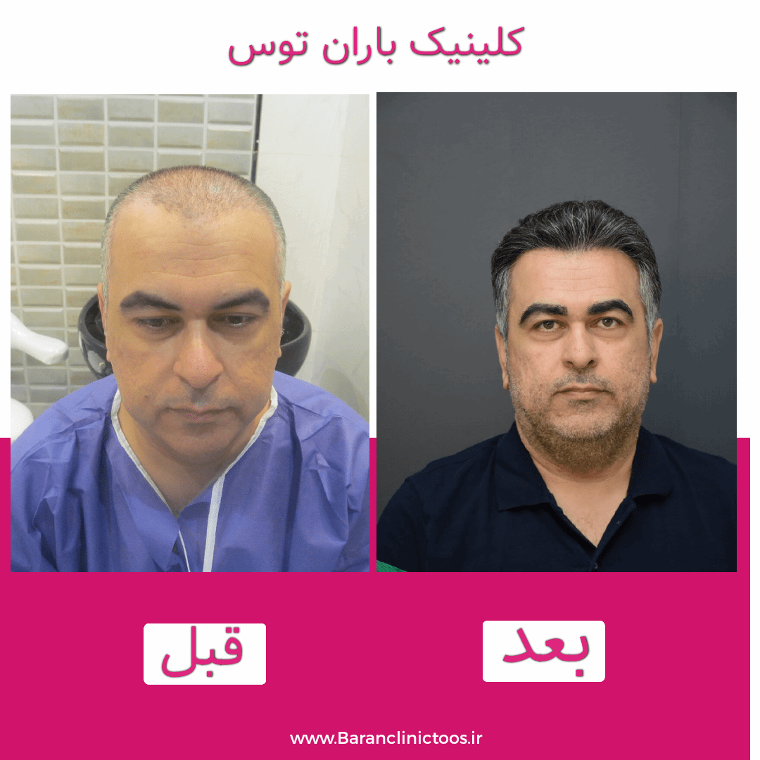 قبل و بعد کاشت مو